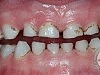 Черные точки на зубах — опасно ли это?