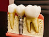 Имплантация зубов под ключ: что представляет собой данная процедура